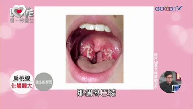 愛+好醫生-第60集 扁桃腺化膿腫大